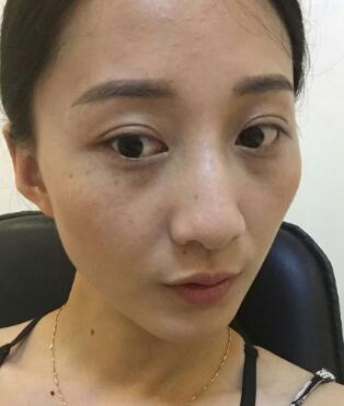 有誰(shuí)做過(guò)激光祛雀斑?個(gè)人激光祛雀斑后恢復(fù)日記分享