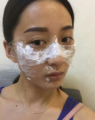 有誰(shuí)做過(guò)激光祛雀斑?個(gè)人激光祛雀斑后恢復(fù)日記分享