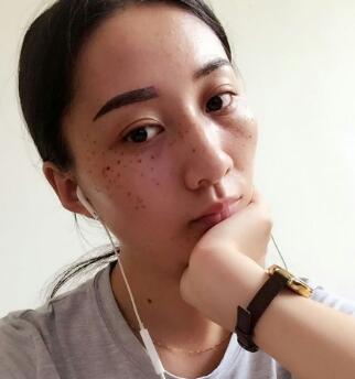 有誰(shuí)做過(guò)激光祛雀斑?個(gè)人激光祛雀斑后恢復(fù)日記分享