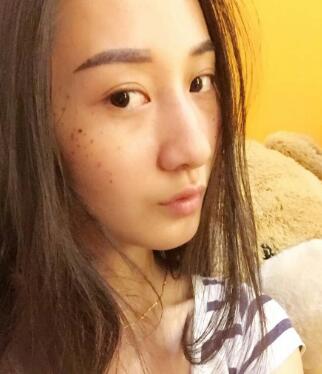 有誰(shuí)做過(guò)激光祛雀斑?個(gè)人激光祛雀斑后恢復(fù)日記分享