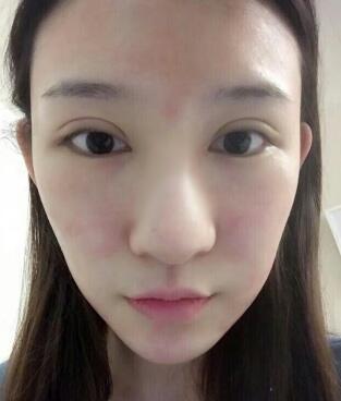 隆鼻失敗修復(fù)后恢復(fù)圖分享,鼻子修復(fù)價(jià)格9800元