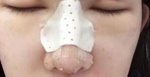 隆鼻失敗修復(fù)后恢復(fù)圖分享,鼻子修復(fù)價(jià)格9800元