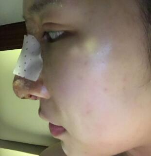 隆鼻失敗修復(fù)后恢復(fù)圖分享,鼻子修復(fù)價(jià)格9800元