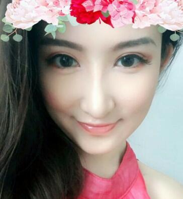 隆鼻失敗修復(fù)后恢復(fù)圖分享,鼻子修復(fù)價(jià)格9800元