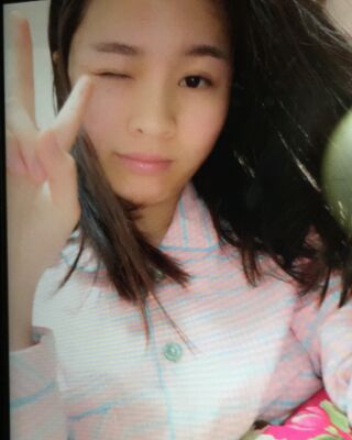 激光祛痘三次對(duì)比圖，痘痘全消除了