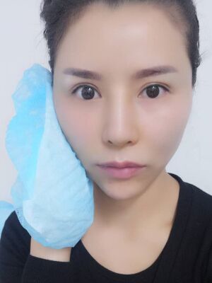 臉部埋埋蛋白線.提升果圖，真實經歷分享