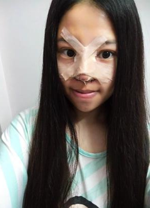 鼻部綜合整形恢復(fù)過(guò)程圖分享