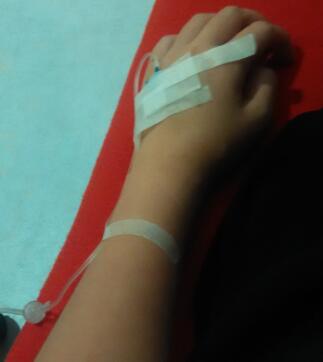 鼻部綜合整形恢復(fù)過(guò)程圖分享