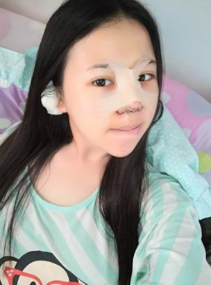 鼻部綜合整形恢復(fù)過(guò)程圖分享