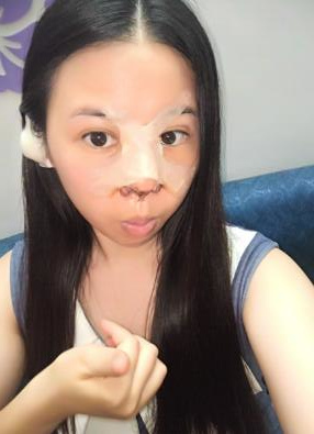 鼻部綜合整形恢復(fù)過(guò)程圖分享