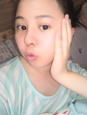 鼻部綜合整形恢復(fù)過(guò)程圖分享