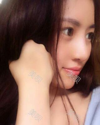 福州愛美爾假體隆鼻失敗后成功修復果圖