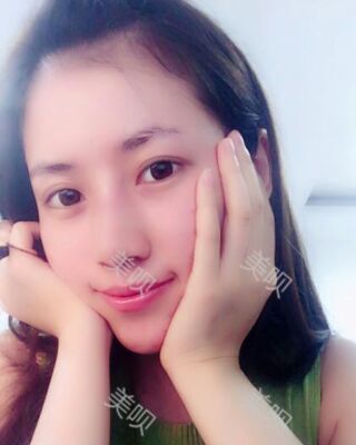 福州愛美爾假體隆鼻失敗后成功修復果圖