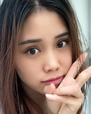 雙眼皮失敗修復(fù)果圖，福州愛美爾王召克做的