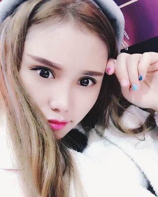 雙眼皮失敗修復(fù)果圖，福州愛美爾王召克做的