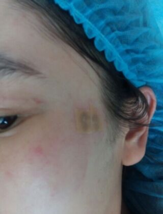 激光去咖啡斑恢復過程，福州美貝爾真實案例