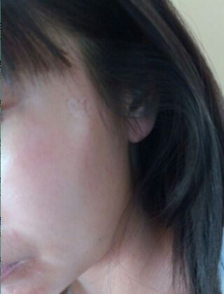 激光去咖啡斑恢復過程，福州美貝爾真實案例