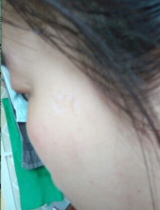 激光去咖啡斑恢復過程，福州美貝爾真實案例