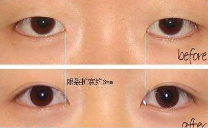 開眼角+割雙眼皮，眼睛整形價格表曝光