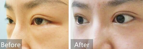 去眼袋前后對比圖，去眼袋價格