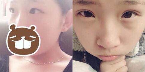 割雙眼皮前后對比圖，眼睛整形價格