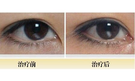 開內(nèi)眼角前后對比圖，眼睛整形價格