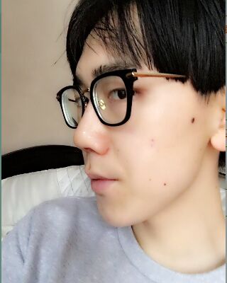 男生隆鼻整形案例分享，福州美貝爾張潮做的