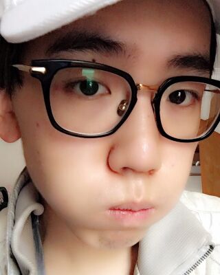 男生隆鼻整形案例分享，福州美貝爾張潮做的