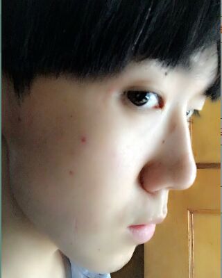 男生隆鼻整形案例分享，福州美貝爾張潮做的