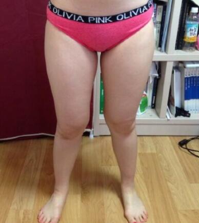 抽脂減肥瘦大腿價(jià)格10800元，一個(gè)月后恢復(fù)很好