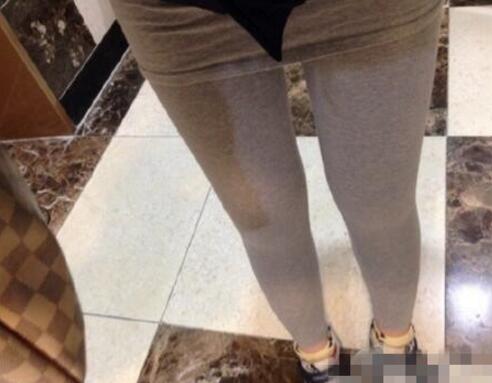 抽脂減肥瘦大腿價(jià)格10800元，一個(gè)月后恢復(fù)很好