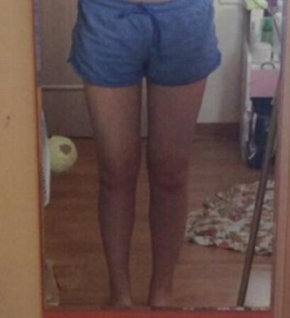 抽脂減肥瘦大腿價(jià)格10800元，一個(gè)月后恢復(fù)很好