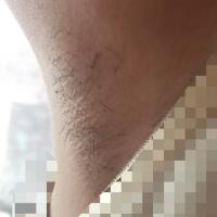 激光脫毛的價(jià)格380元，圖片分享