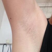 激光脫毛的價(jià)格380元，圖片分享