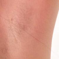 激光脫毛的價(jià)格380元，圖片分享