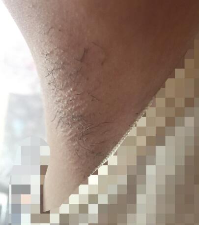 激光脫毛的價(jià)格380元，激光脫毛圖片分享