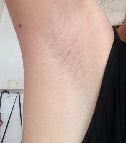 激光脫毛的價(jià)格380元，激光脫毛圖片分享