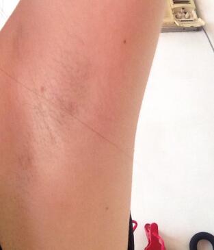 激光脫毛的價(jià)格380元，激光脫毛圖片分享