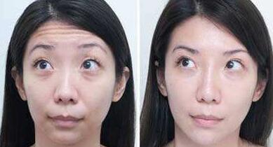 抬頭紋手術(shù)多少錢(qián)？去抬頭紋前后對(duì)比圖
