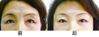 抬頭紋手術(shù)多少錢(qián)？去抬頭紋前后對(duì)比圖