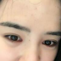 埋線雙眼皮恢復(fù)日志多對比圖分享