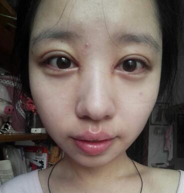 見證全切雙眼皮使單眼皮變雙眼皮的奇跡~恢復過程圖分享