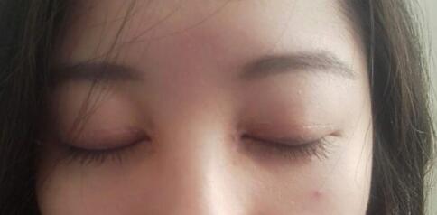見證全切雙眼皮使單眼皮變雙眼皮的奇跡~恢復過程圖分享