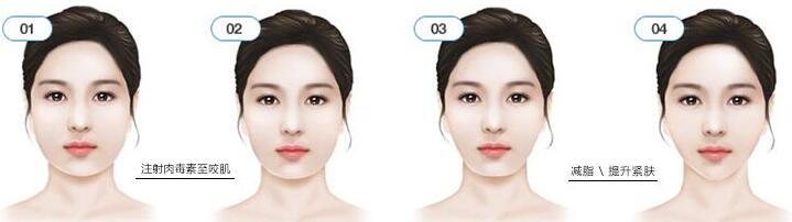 瘦臉前后對比圖，B****的價格曝光