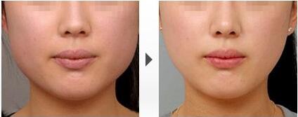 瘦臉前后對比圖，B****的價格曝光