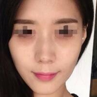 果酸嫩膚多少錢(qián)？我做成890元，果圖分享給大家