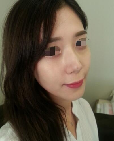 果酸嫩膚多少錢？我做成890元，果圖分享給大家