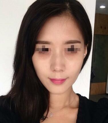 果酸嫩膚多少錢？我做成890元，果圖分享給大家