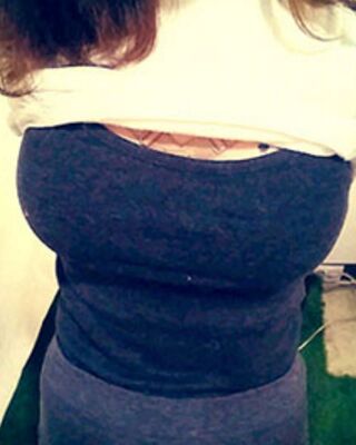 長(zhǎng)沙希美假體隆胸前后對(duì)比果圖，A到C的變化