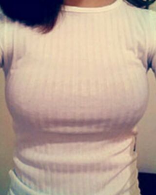 長(zhǎng)沙希美假體隆胸前后對(duì)比果圖，A到C的變化